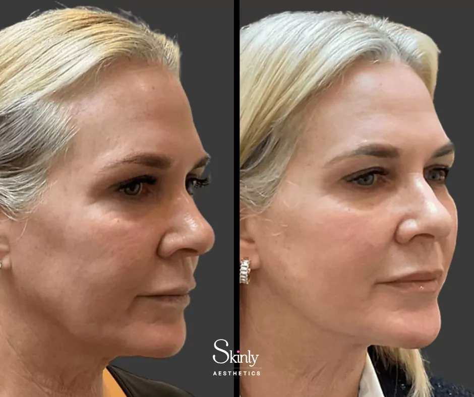 Endolift results showing improved jawline definition and neck contour
