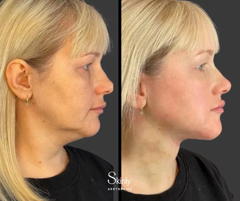Endolift results showing reduction of jowls and improved lower face contour
