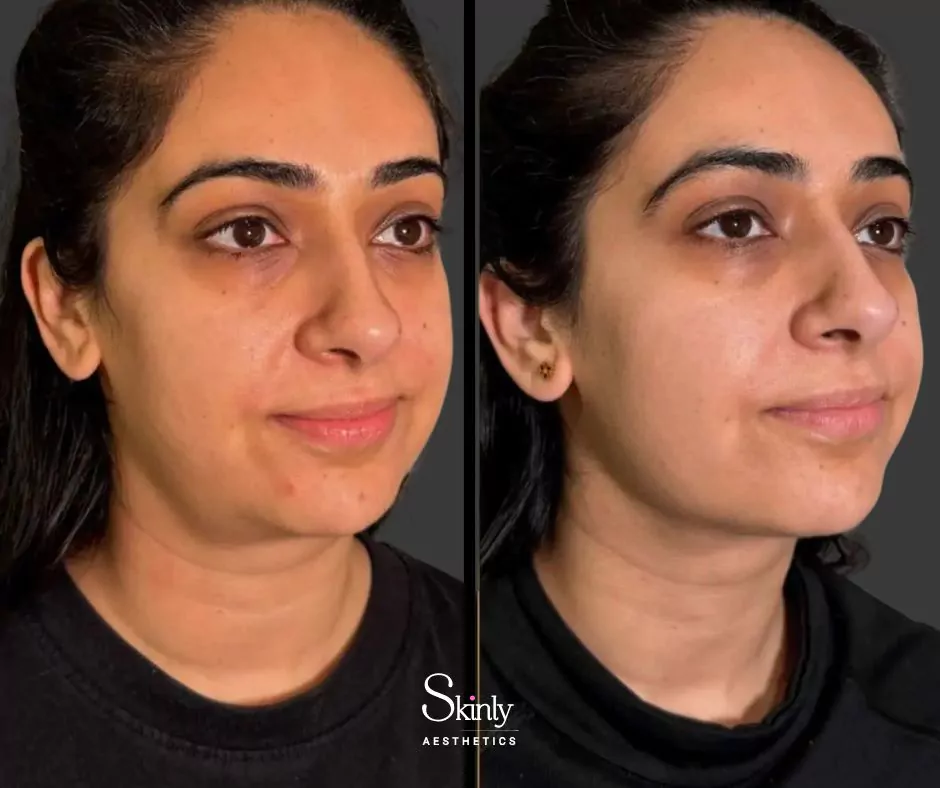 Endolift subtle jawline improvement showing natural contour enhancement
